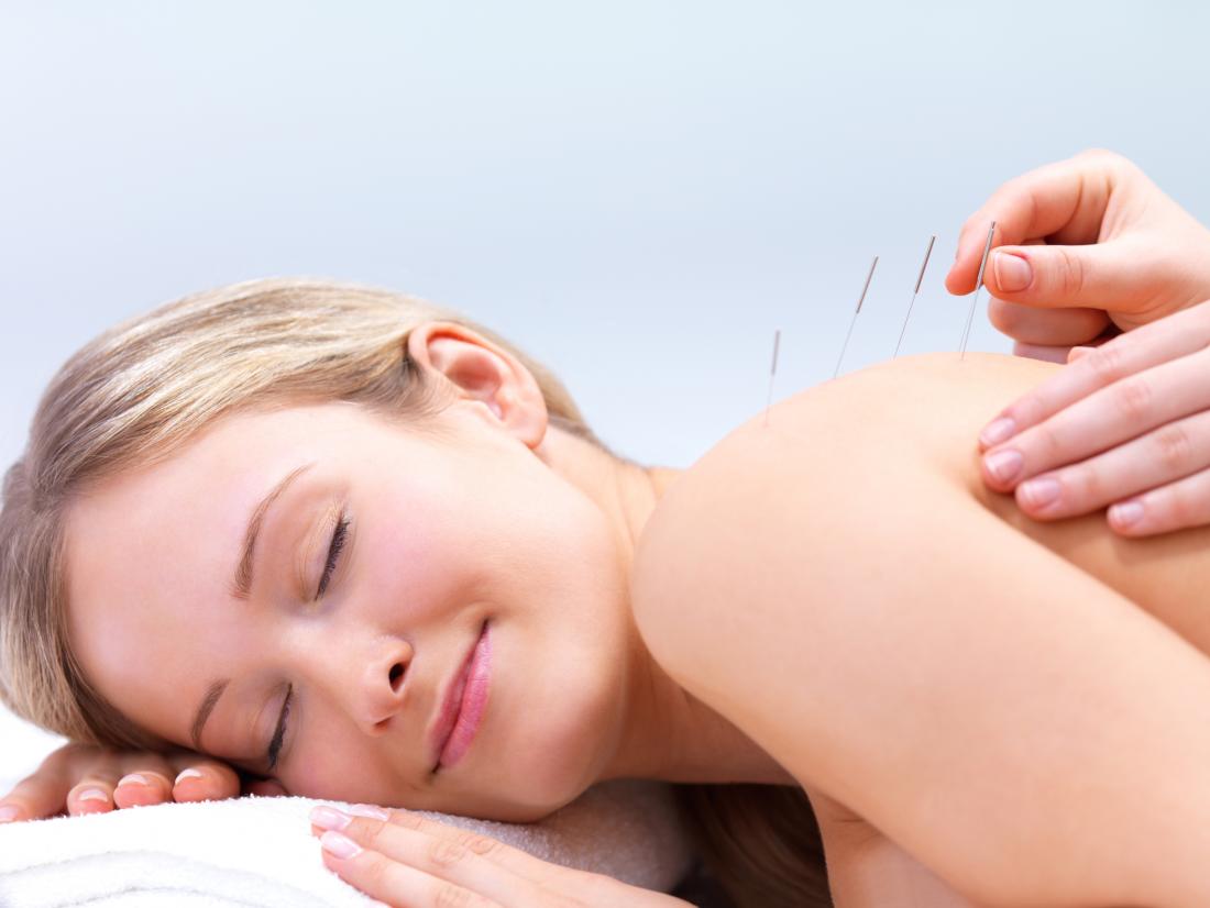 Major Benefits Of dry needle treatment