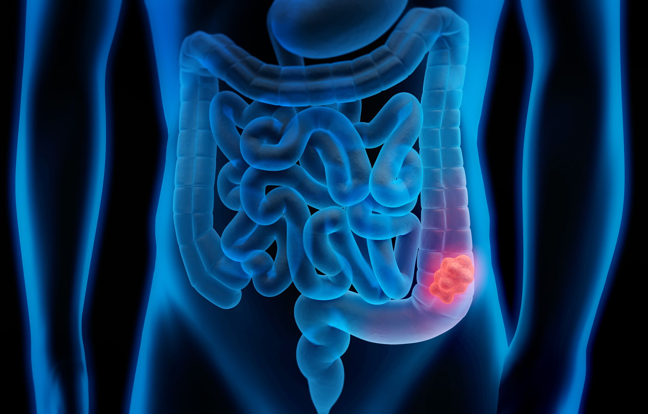 Colon cancer treatment and some preventive methods